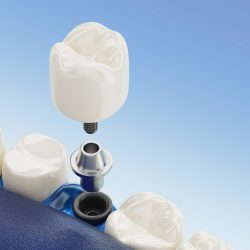 Close up Component of Dental implants transparent. 3D rendering.