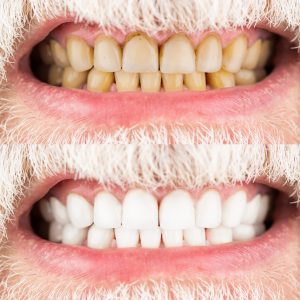 Male teeth before and after whitening, oral care dentistry, stomatology. Smiling man before and after teeth whitening procedure, closeup. Close-up Of A Smiling man Teeth Before And After Whitening.