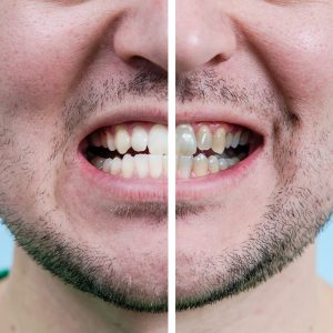 Man Teeth Before And After Whitening. Dentist work photo