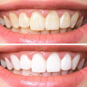 woman teeth before and after whitening. Over white background. Dental clinic patient. Image symbolizes oral care dentistry, stomatology.