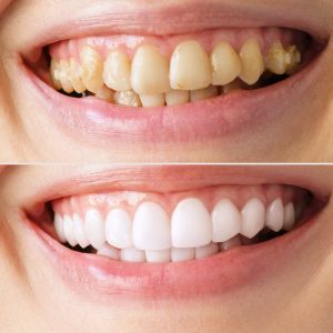 A woman's smile in close-up, before and after the bleaching procedure at the dentist
